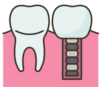 Dental Implant